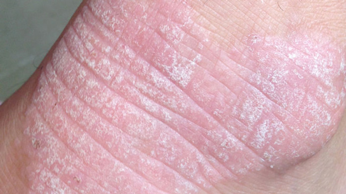 Dermatitis herpetiformis is a common symptom of celiac disease.