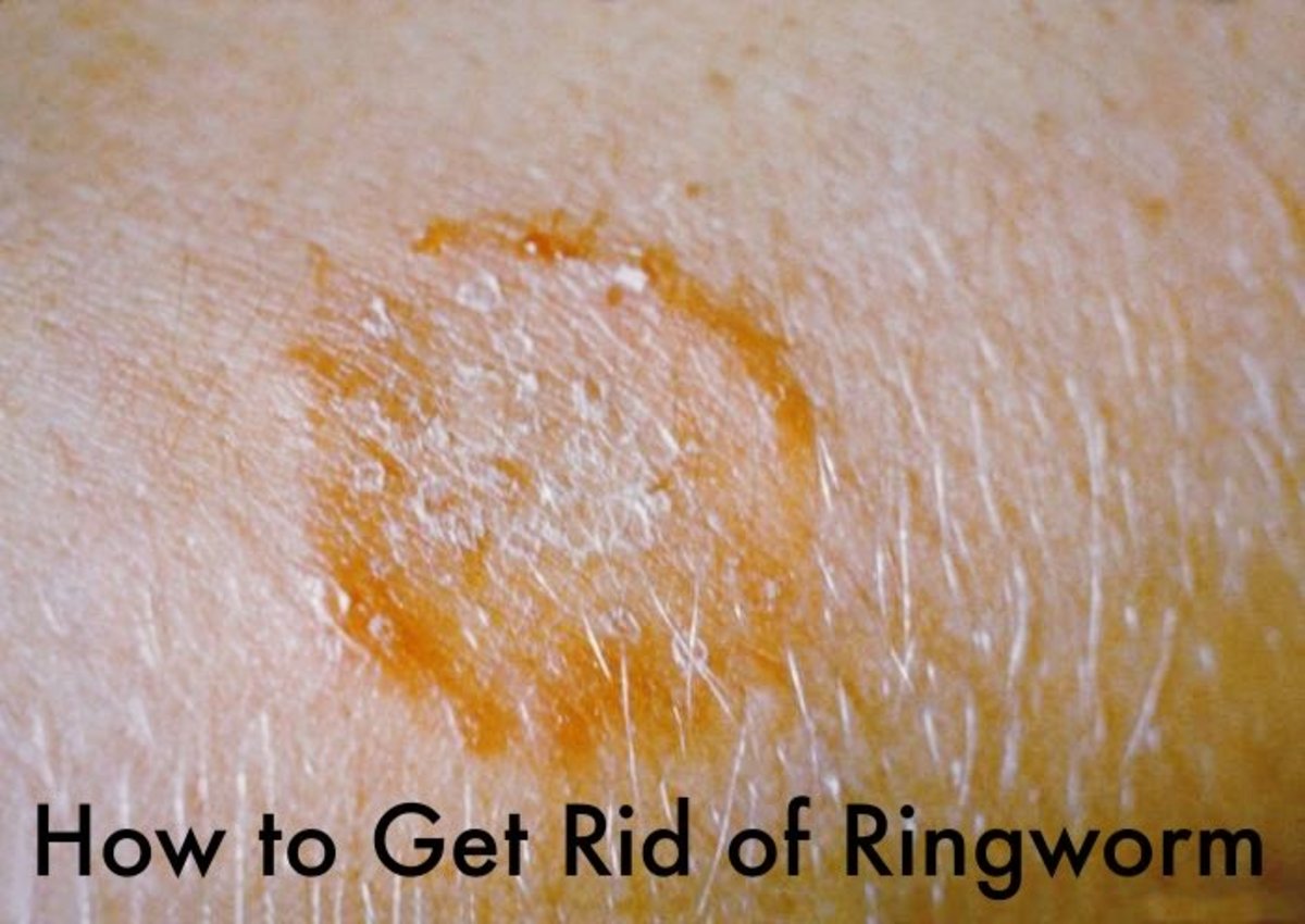 How I Got Rid of Ringworm