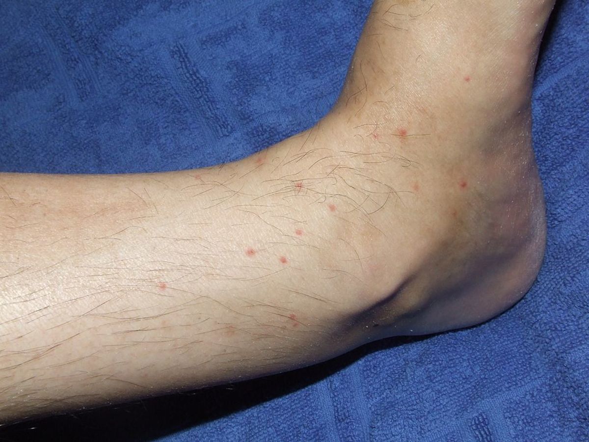 Flea bites on the lower leg. 