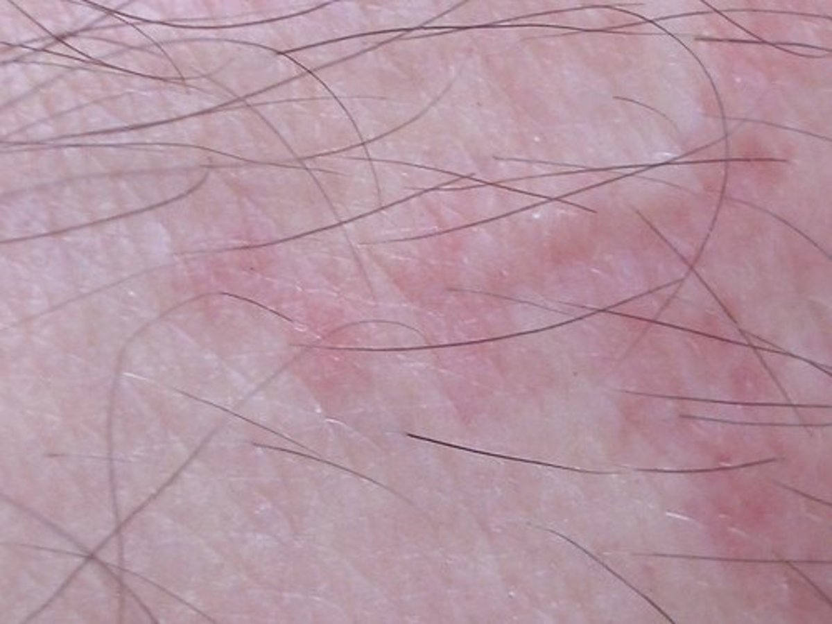 Bites may take hours or days to show up on the skin.