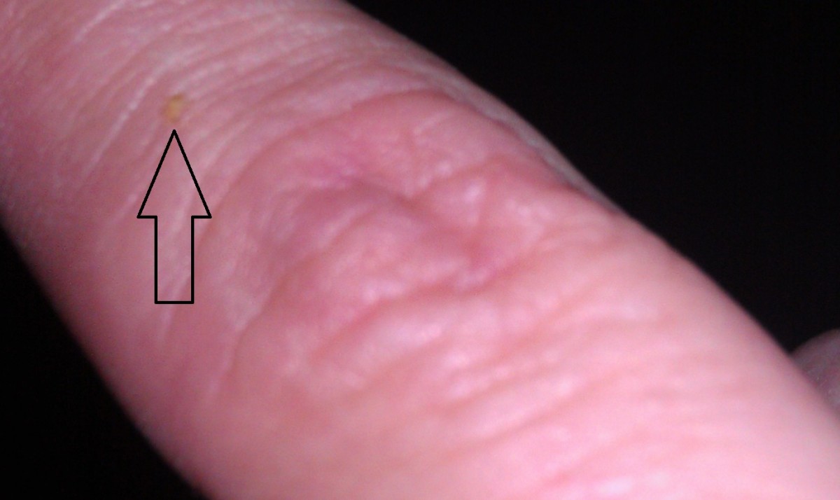 This picture shows a baby bedbug on a woman's finger. It is white and so tiny that you almost cannot see it. 