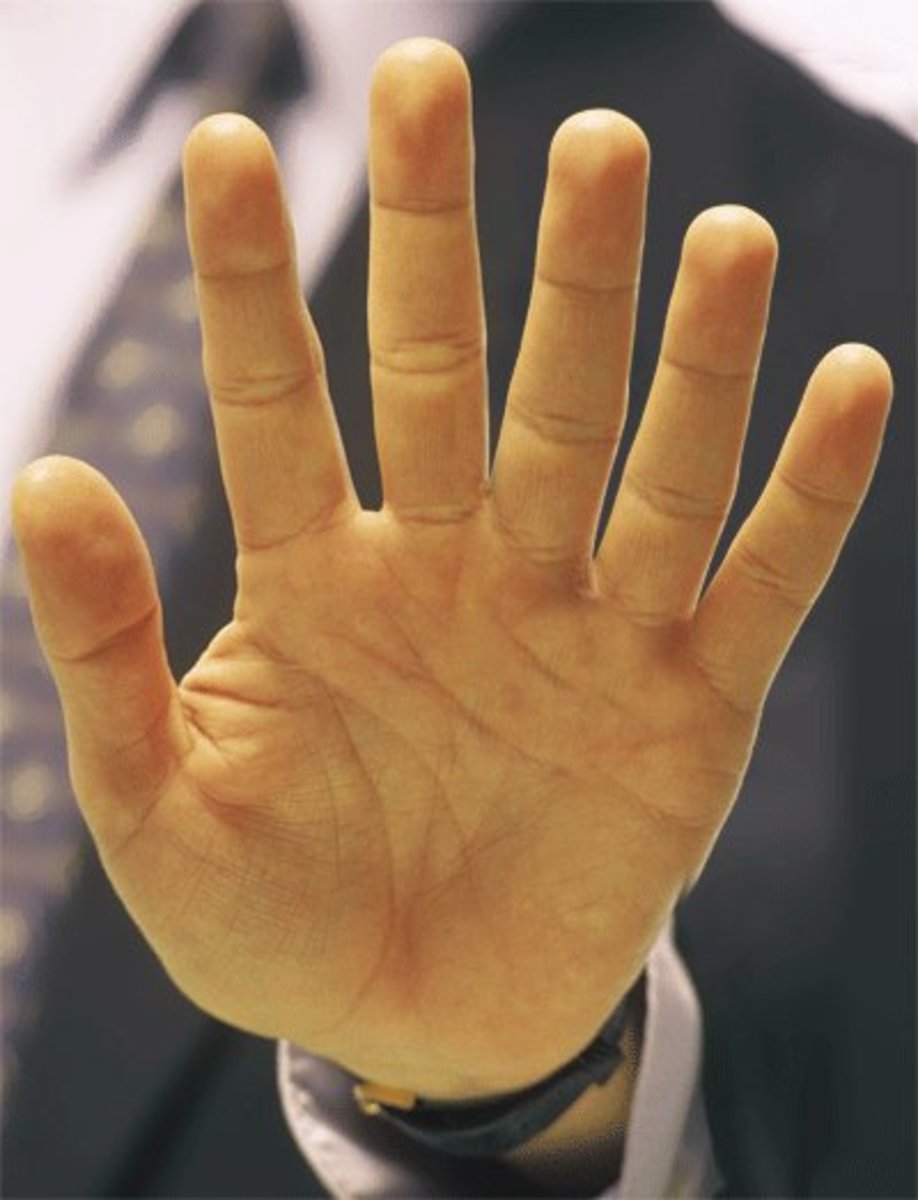 Extra fingers as a result of polydactyly