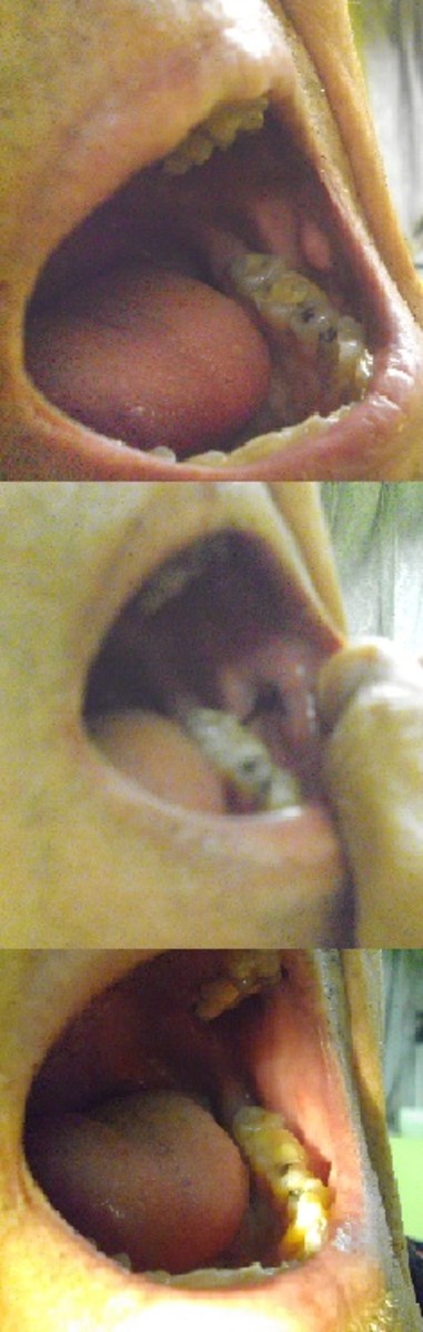 During one of my recent dental visits, I showed the dentist the small growth inside the left portion of my mouth, between the two rows of teeth.