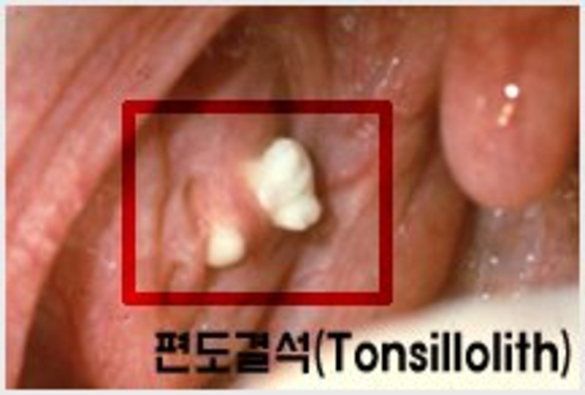 Here's another big tonsil stone.