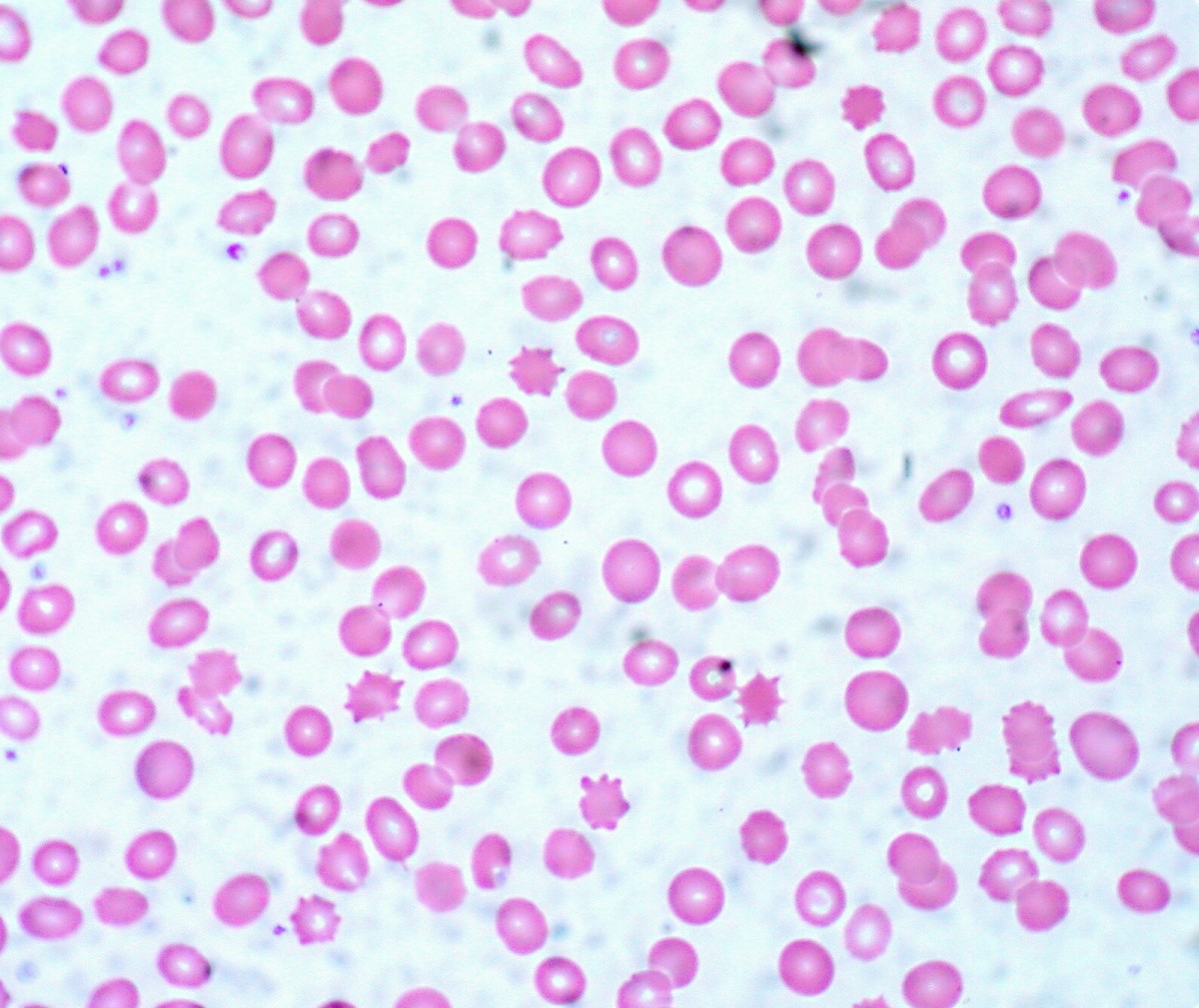 Normal and abnormal red blood cells as seen under a microscope; the spiky ones are present in certain diseases and are called acanthocytes