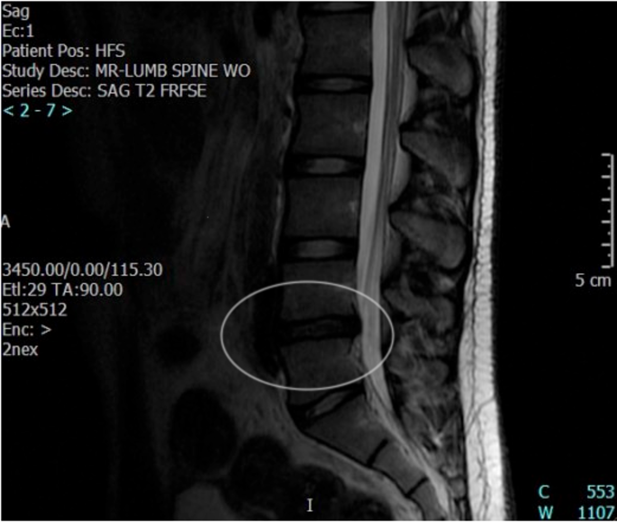 This is an MRI of my son's L4-L5 herniated disc (I believe).