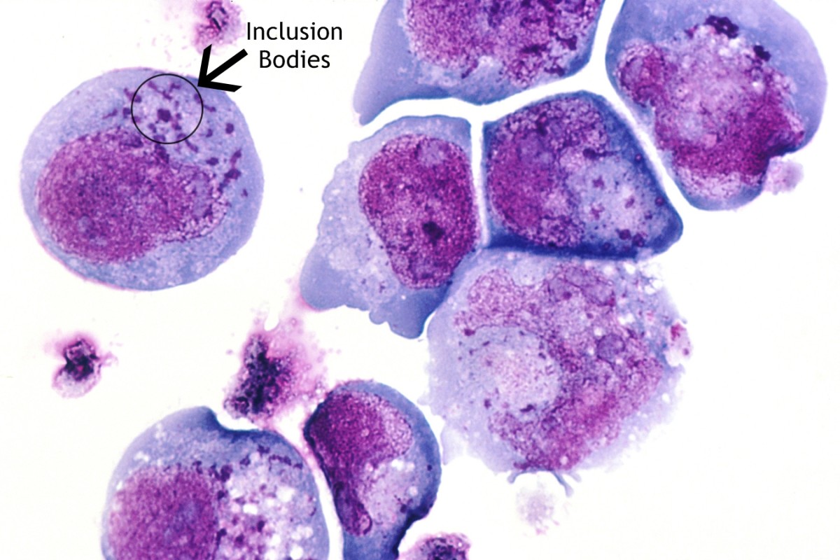 Inclusion bodies (sites of viral replication) in a cell infected with Herpes Virus 6