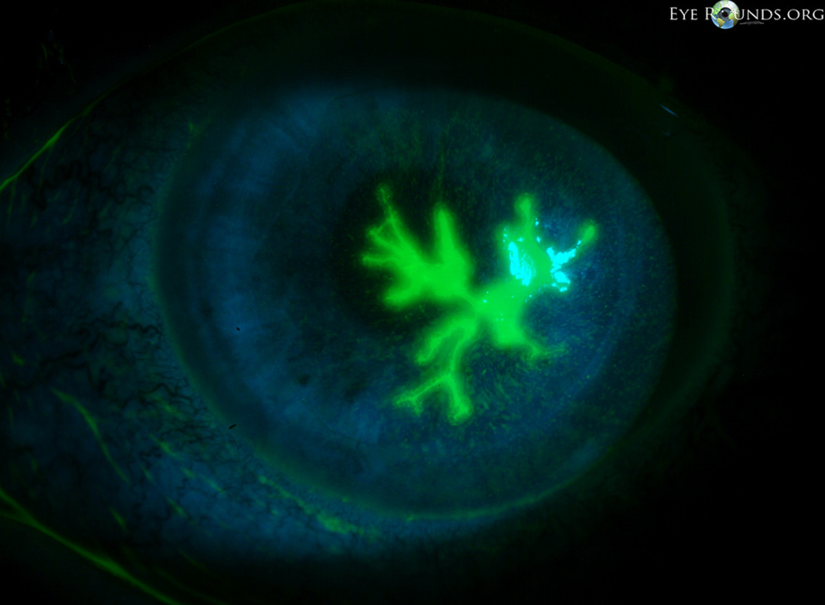 A dendritic corneal ulcer stained with fluorescein.