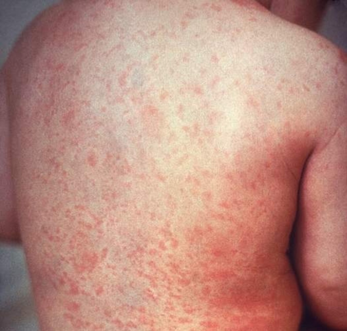 A rubella rash