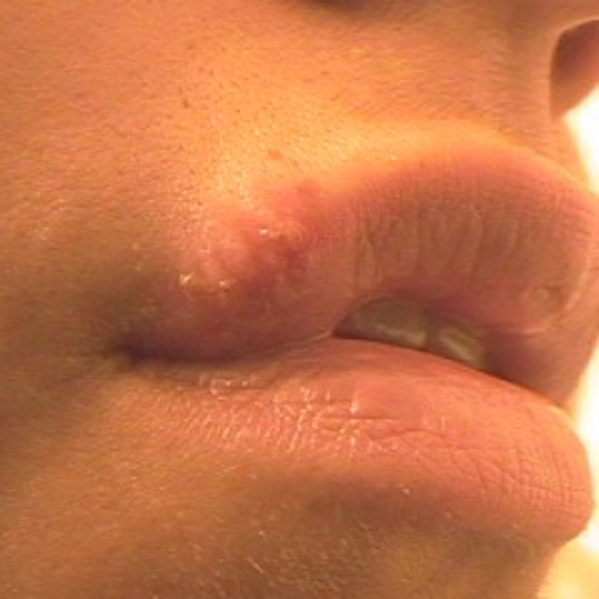 Get rid of cold sores faster by supplementing your diet.