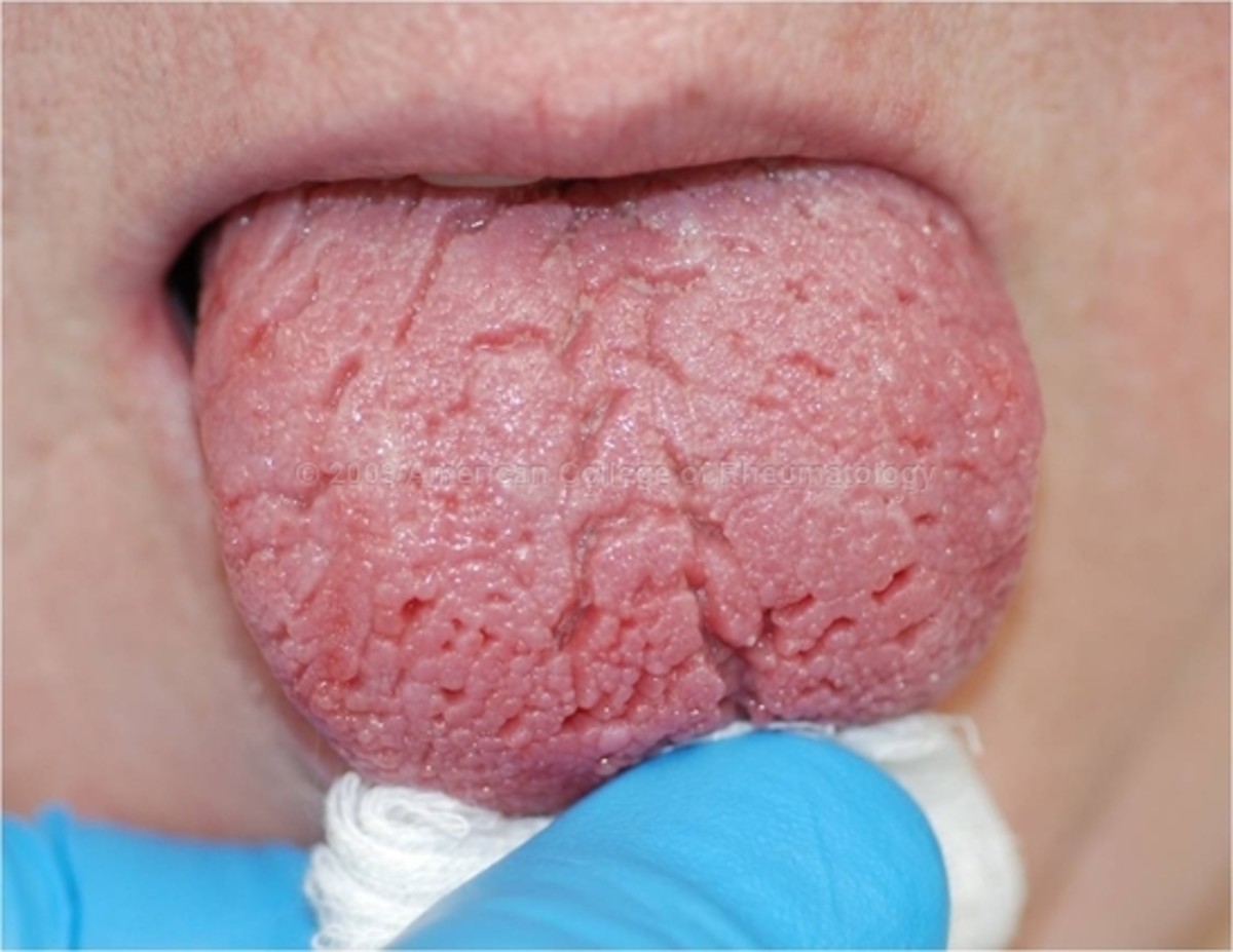 Sicca is a symptom of Sjögren's syndrome and is characterized by dry tongue and eyes.