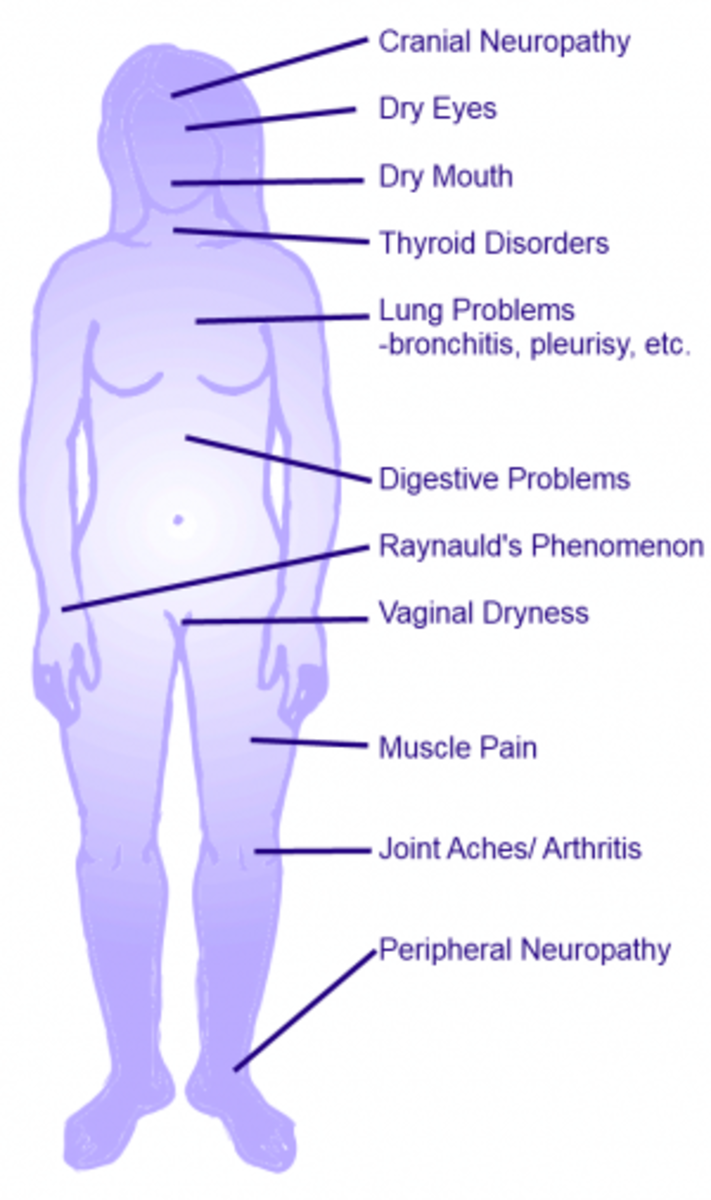 7 Symptoms of Sjögren’s Syndrome YouMeMindBody