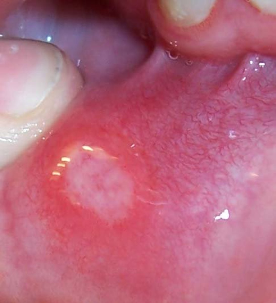 A canker sore on the inner lip. Published under GFDL in English Wiki, CC BY-SA 3.0