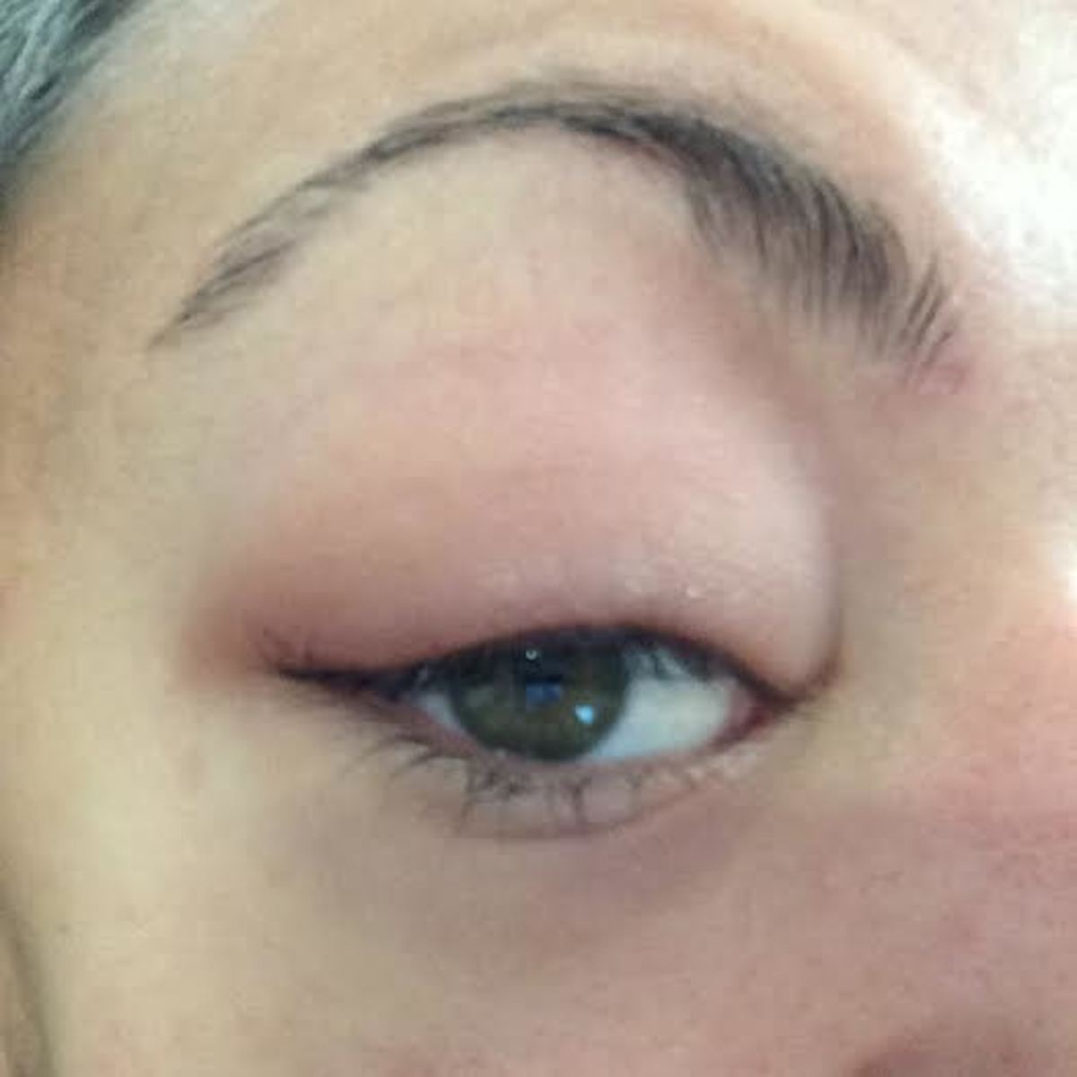 What a blepharitis flare-up looks like.