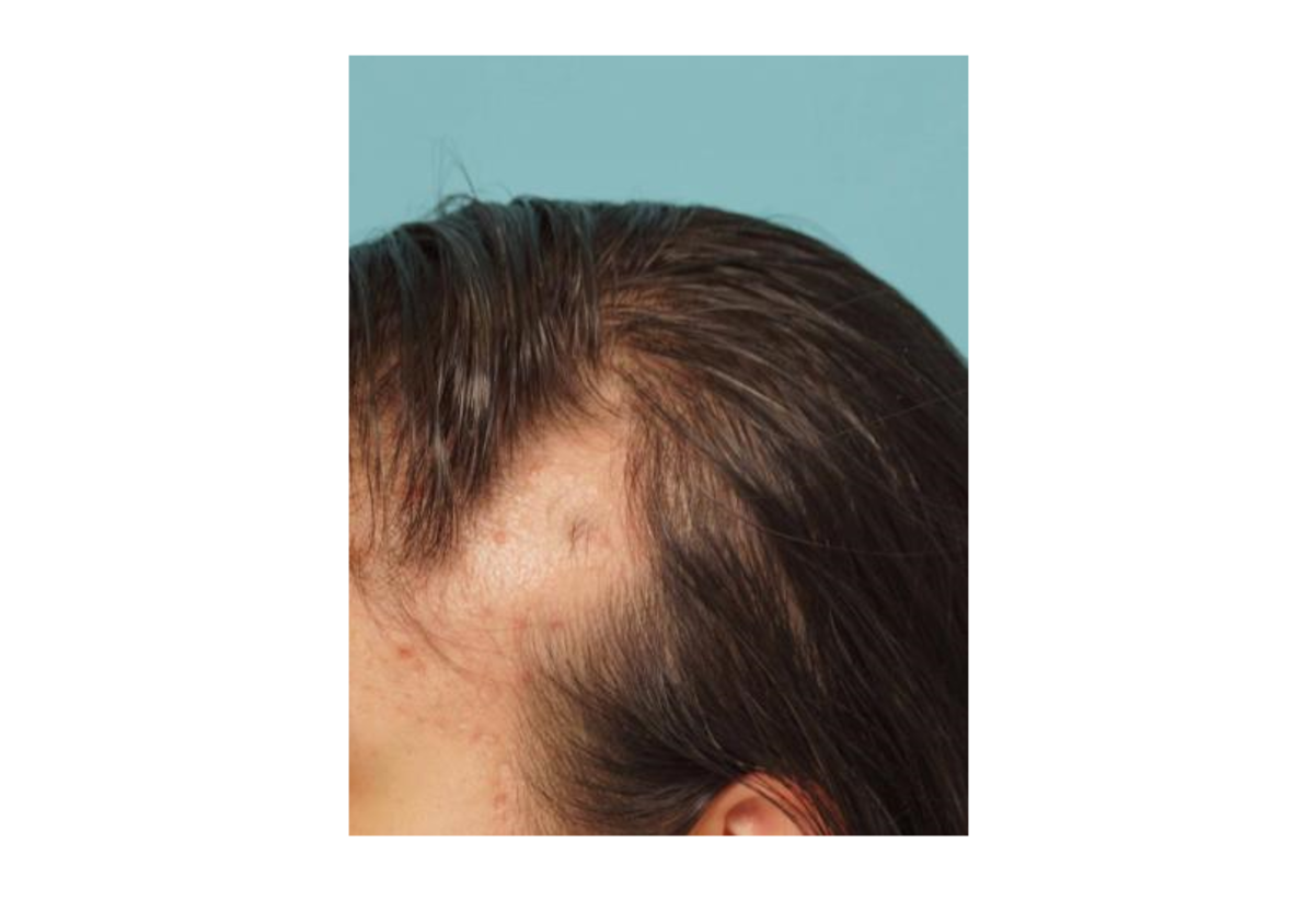 Triangular alopecia