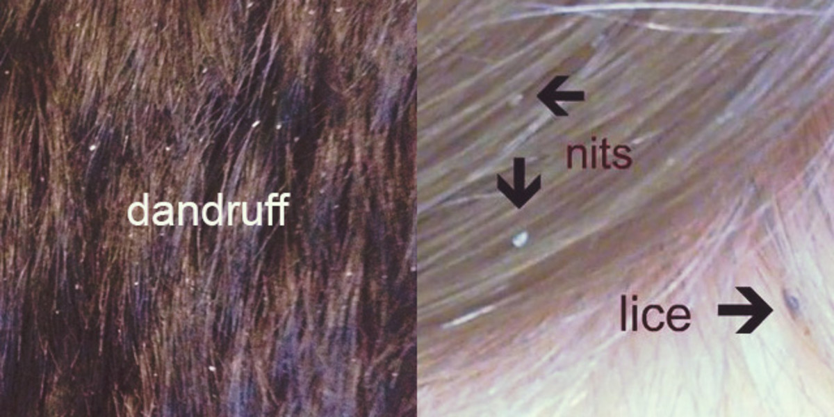 Is it dandruff or is it lice? They can be hard to distinguish.