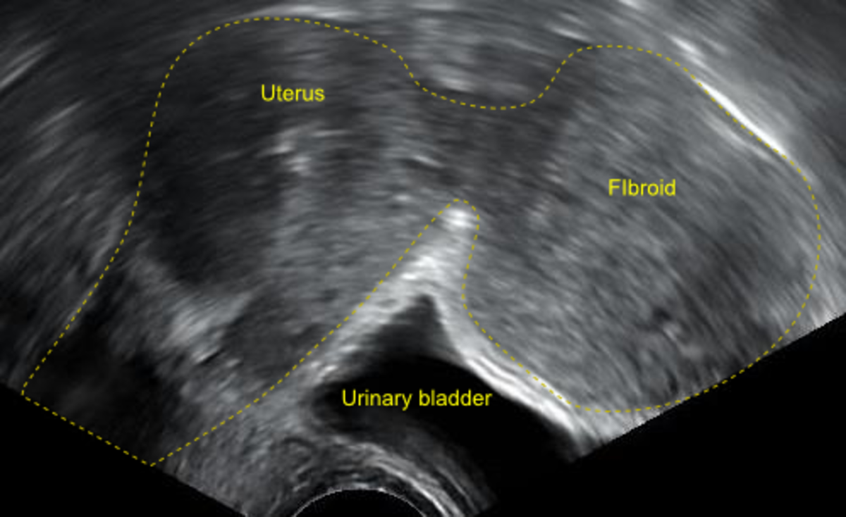 A transvaginal ultrasonography showing a subserosal uterine fibroid with a diameter of 5 centimeters.