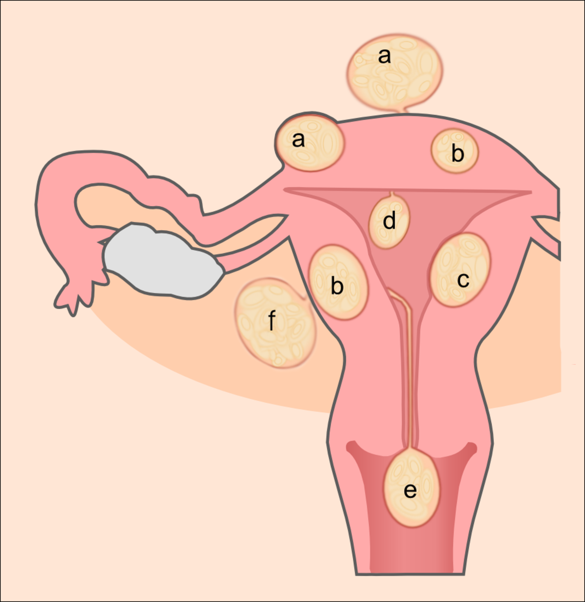 Schematic showing the placement of six types of uterine fibroids within the womb