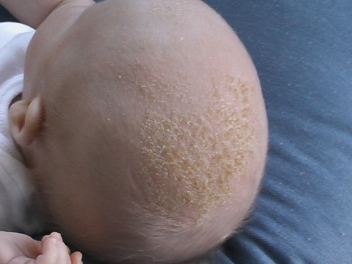 Cradle cap is common and often occurs alongside diaper rash. The condition is harmless and if left alone usually clears up without intervention. However, it can also be treated with steroid creams