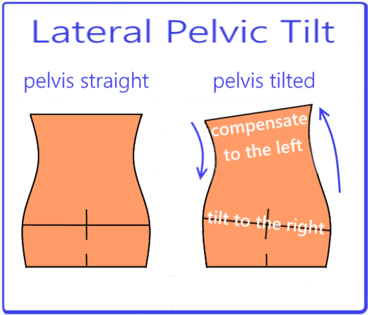 Habitually carrying the body weight in standing on one leg and always on the same leg, can cause a lateral pelvic tilt.