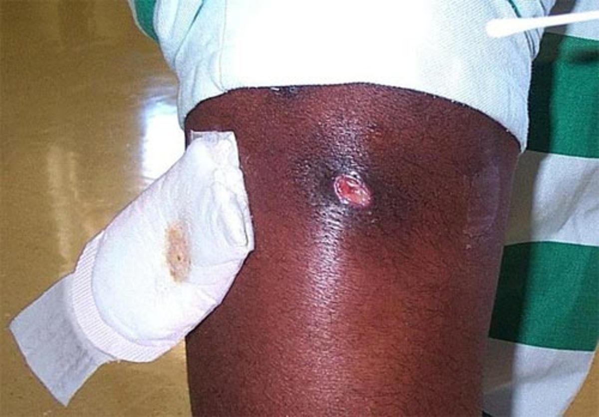 Infection on the arm