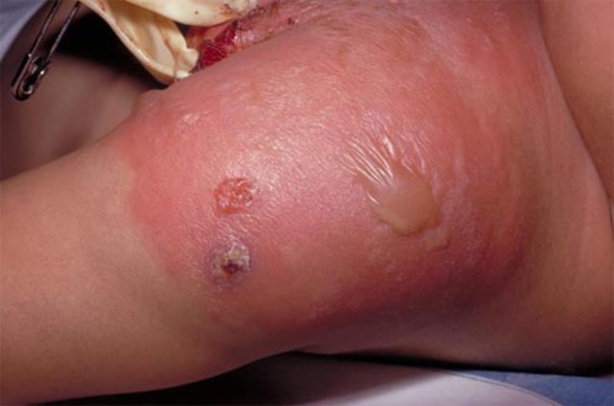 A secondary staphylococcal infection at a smallpox vaccination site.