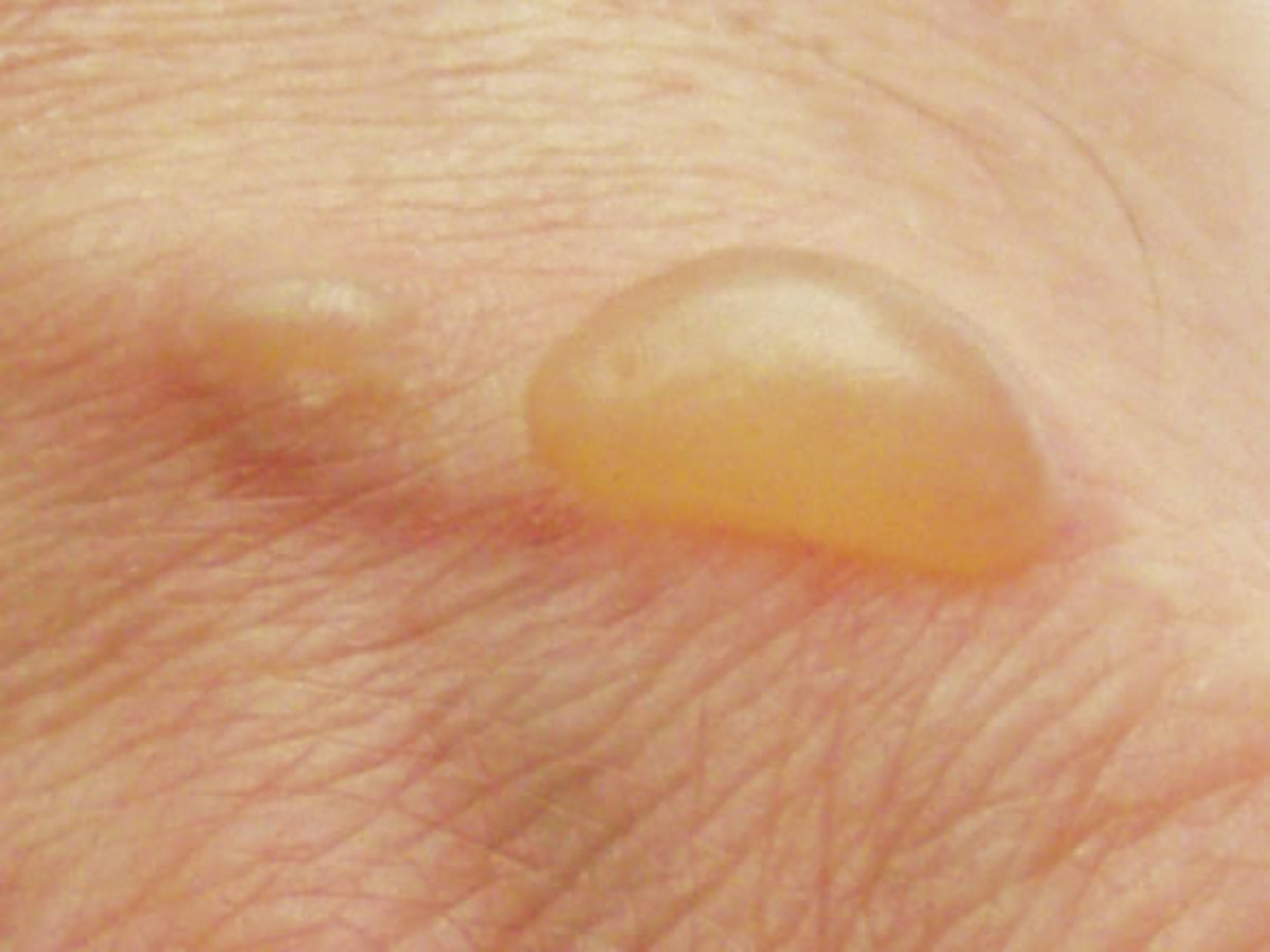 Leg blisters such as this can be dangerous. See your doctor (public domain)