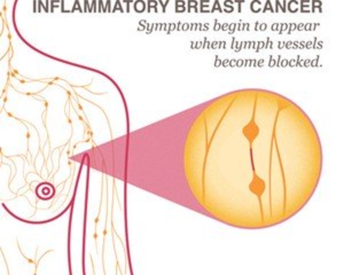 The Silent Killer: Inflammatory Breast Cancer Pictures and Early Detection