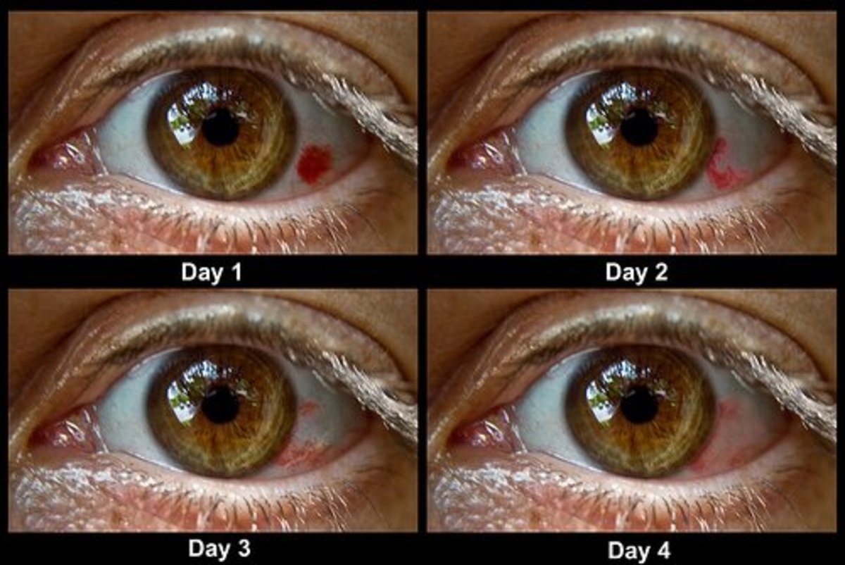 what-causes-broken-blood-vessels-in-the-eyes