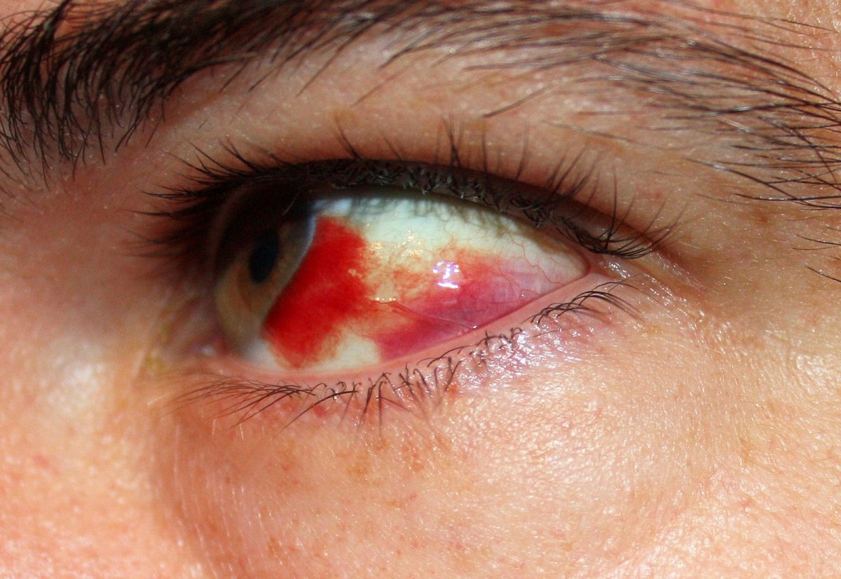 Broken blood vessels in the eye are typically caused by high blood pressure. 