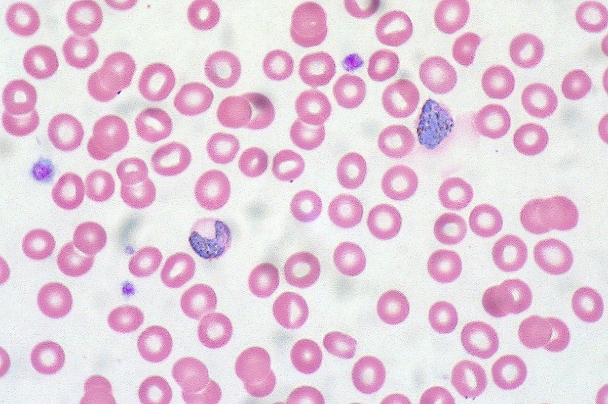 A stained slide showing the malarial parasite (blue) in blood and the red blood cells