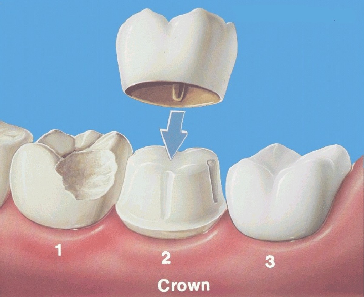 After a root canal procedure, dentists will often place a cap over the affected tooth. 