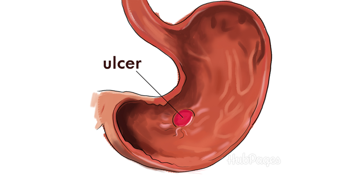 An ulcer is one cause of abdominal pain that requires medical attention.