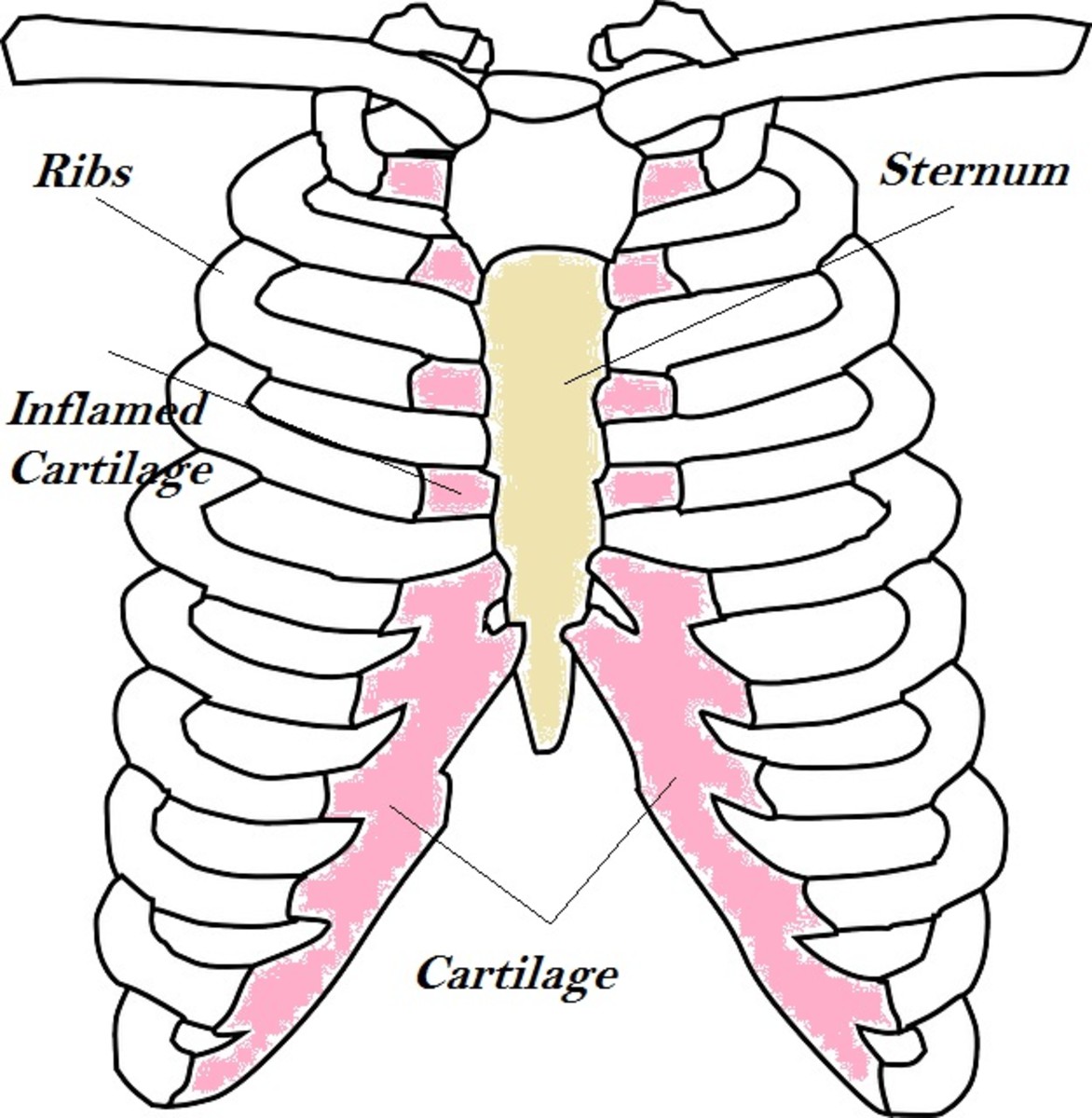 The inflamed cartilage puts pressure on the chest, which causes pain.