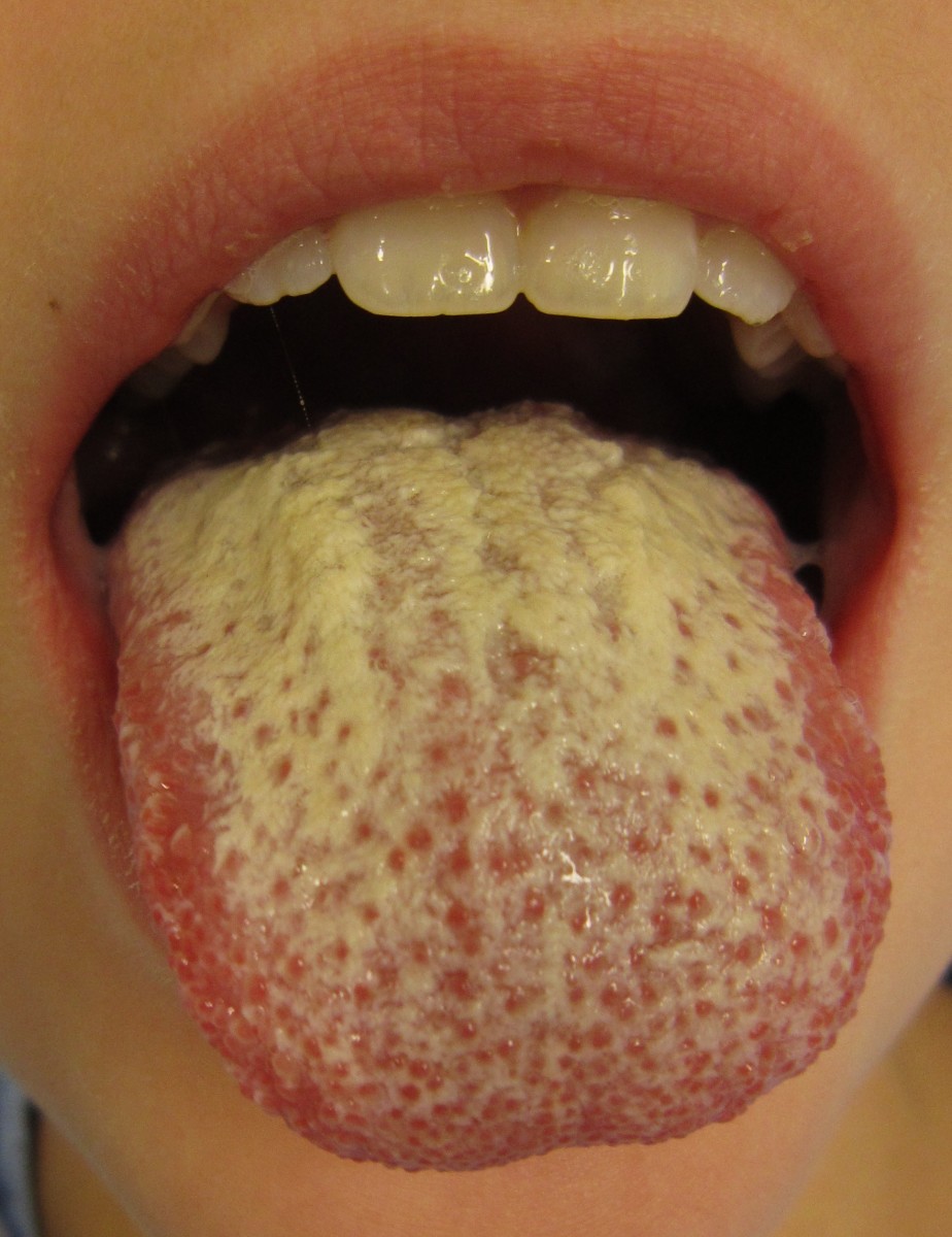 Tongue Thrush