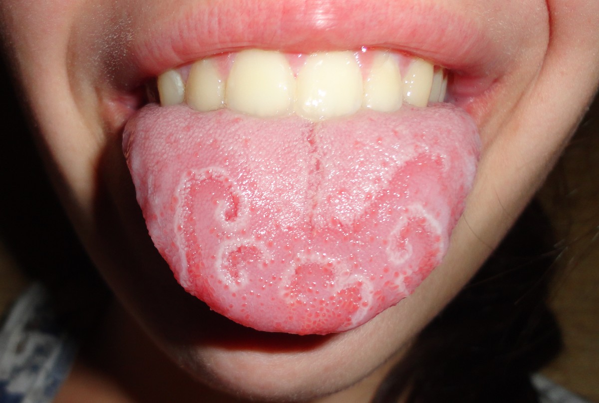 An especially interesting example of a geographic tongue