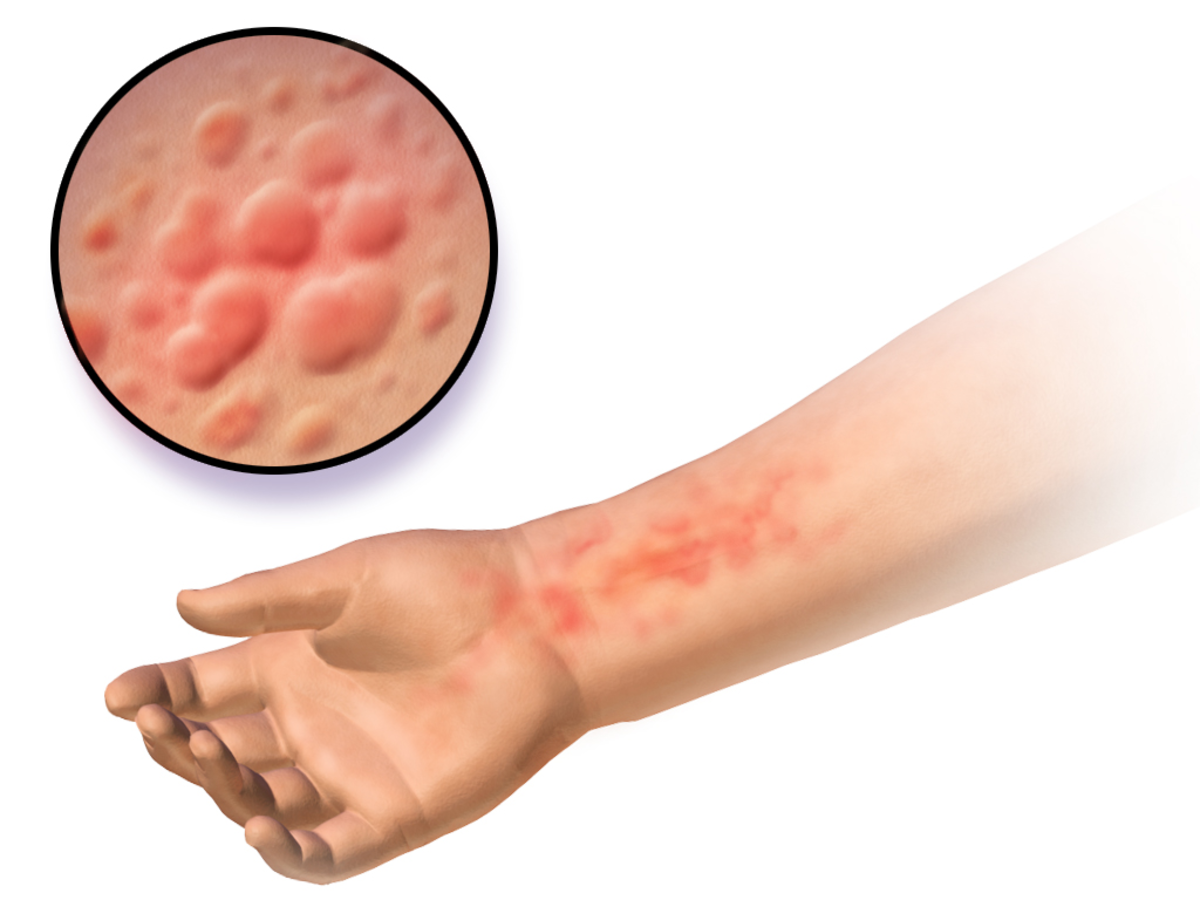 A medical illustration depicting urticaria