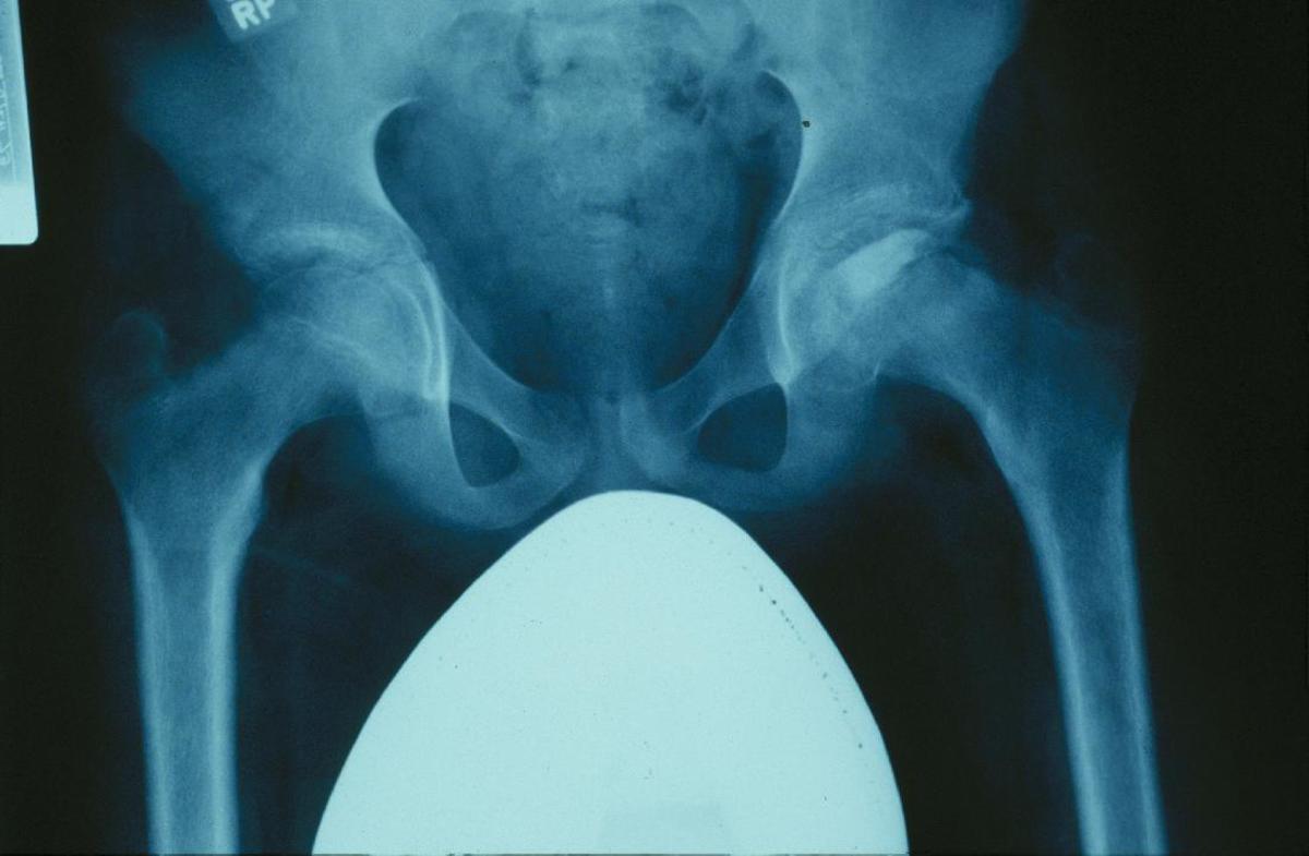 Legg-Calve'-Perthes Disease of the left hip.