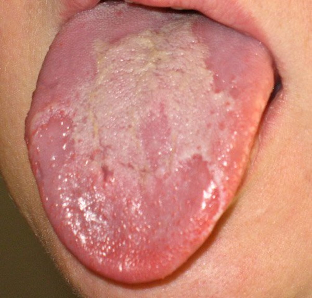 An image of a geographic tongue.