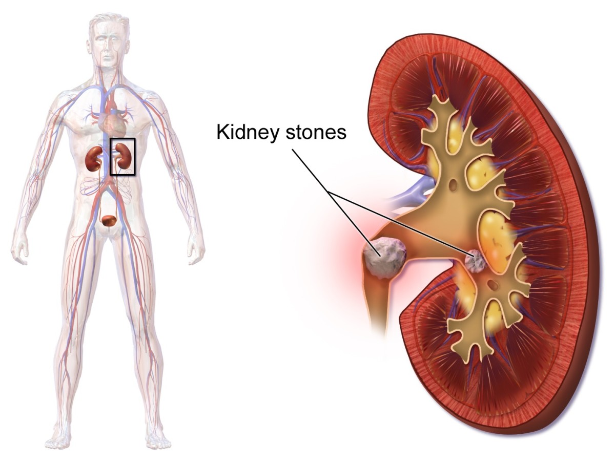 The kidneys and kidney stones