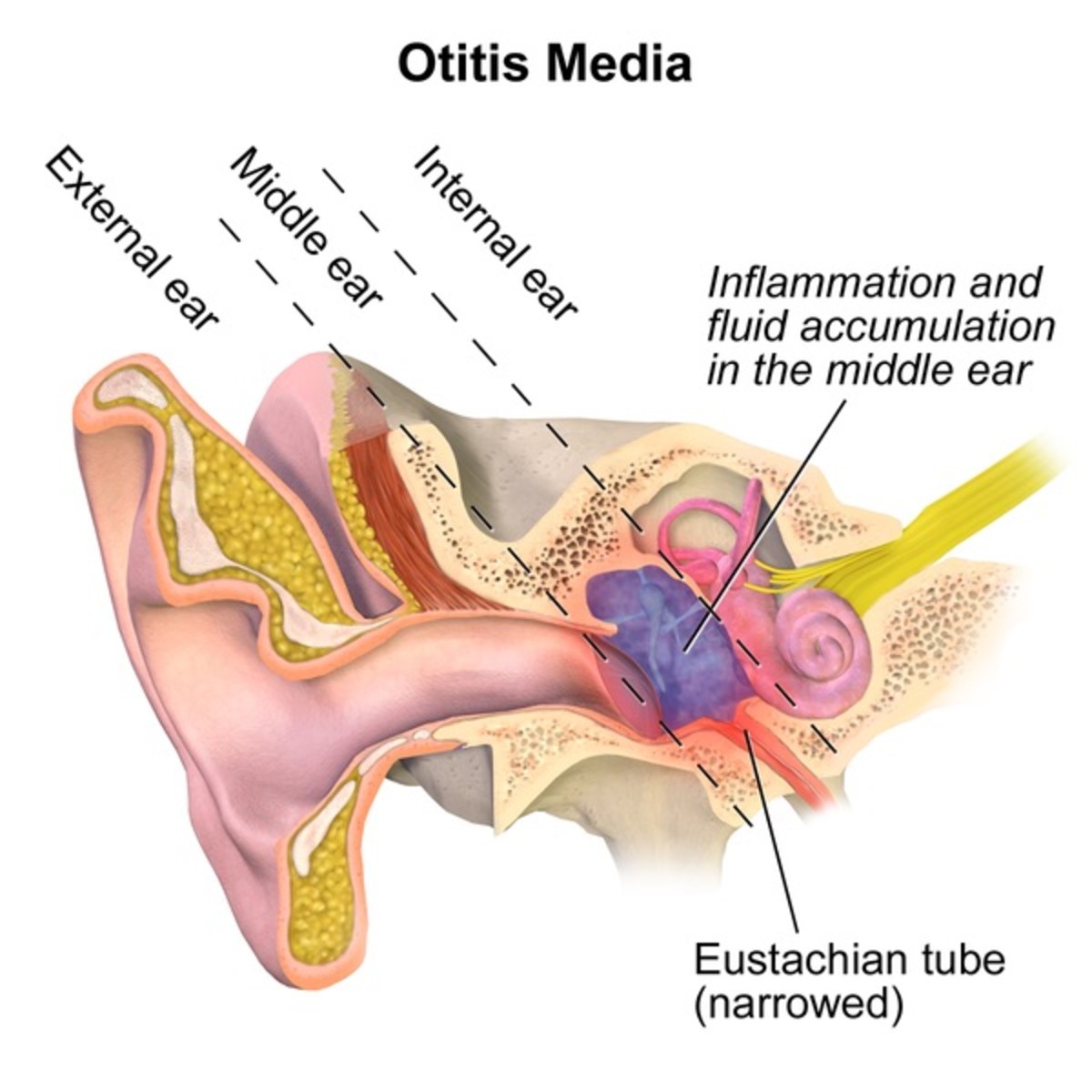 Fluid accumulation in the middle ear in otitis media