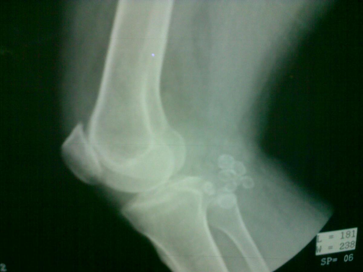 X-ray of the knee joint