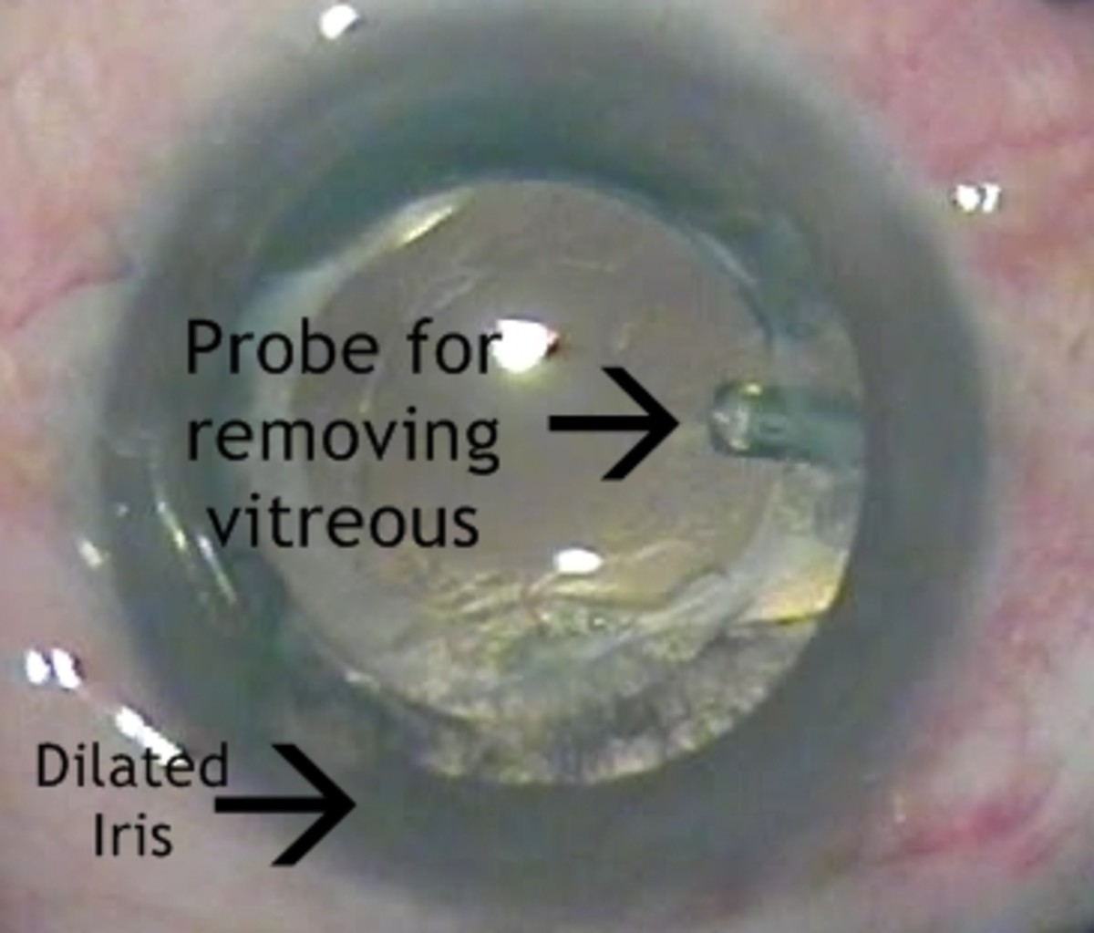 Image of a vitrectomy in progress