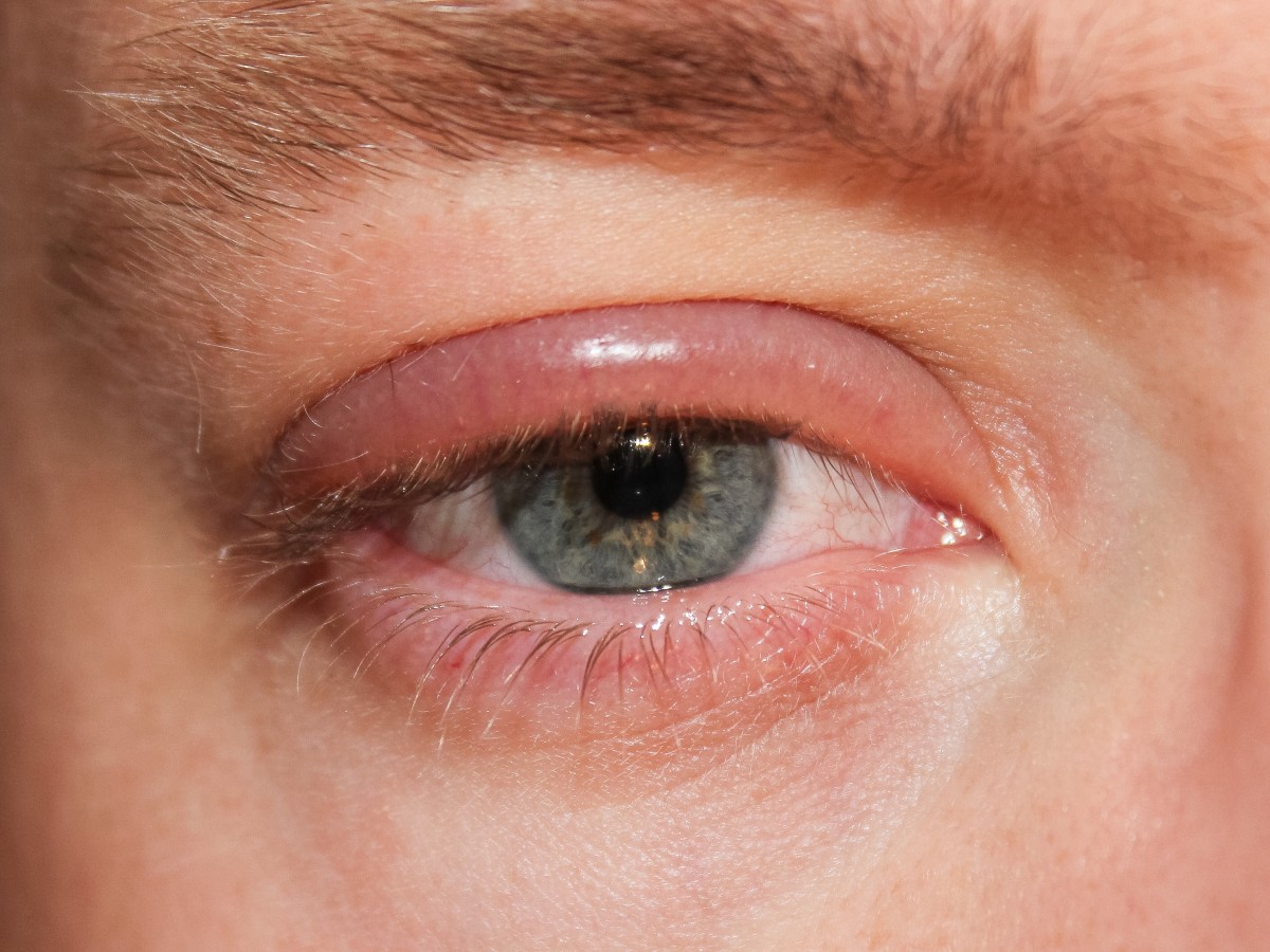 Facts About Conjunctivitis (Pink Eye) in Older Adults - HubPages