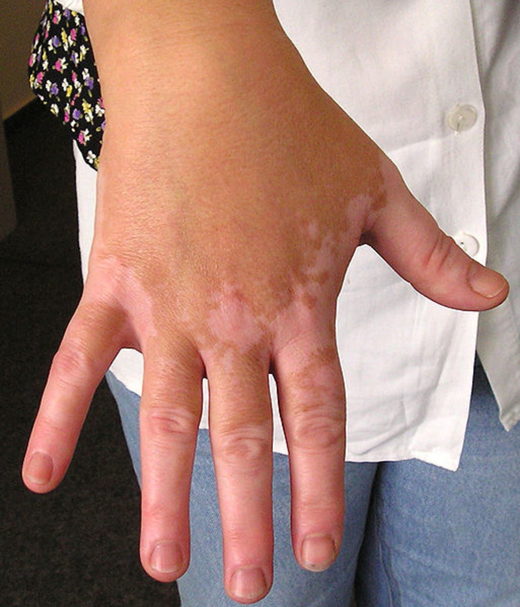 Vitiligo on someone's hand