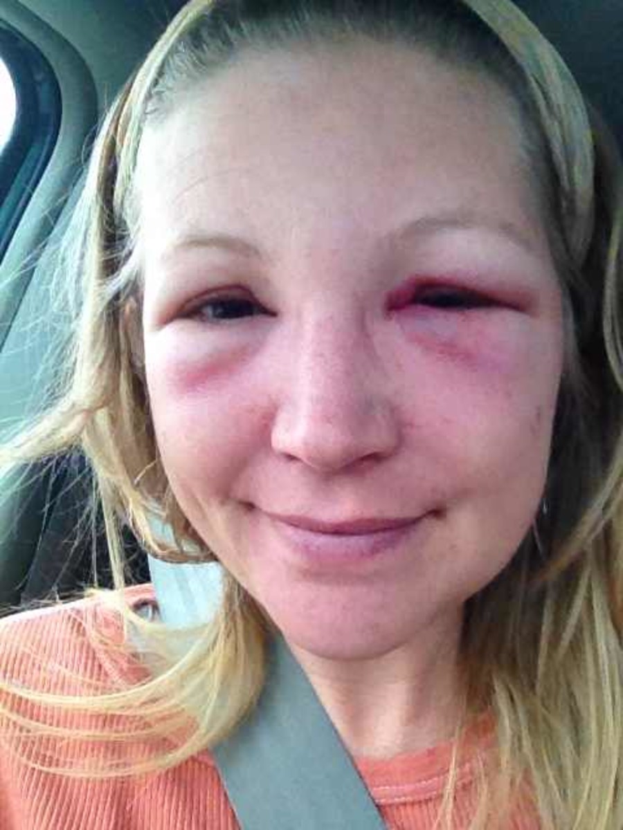 My Experience Of A Bee Sting Near My Eye With Photo