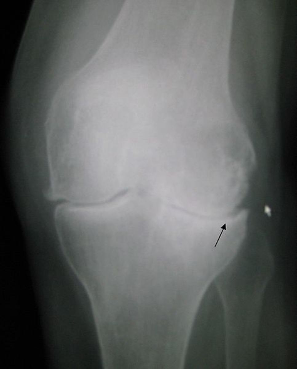 X-ray showing osteoarthritis of the knee.