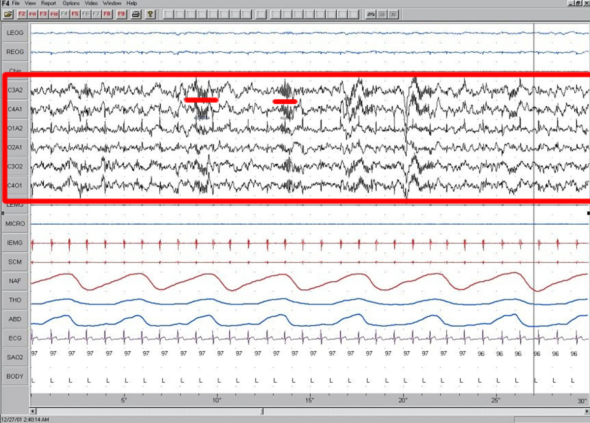 Stage 2 sleep EEG. Stage 2 sleep is marked by theta waves, sleep spindles, and K-complexes.