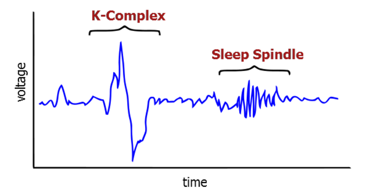 Sleep spindles and K-complexes are common in Stage 2 sleep.