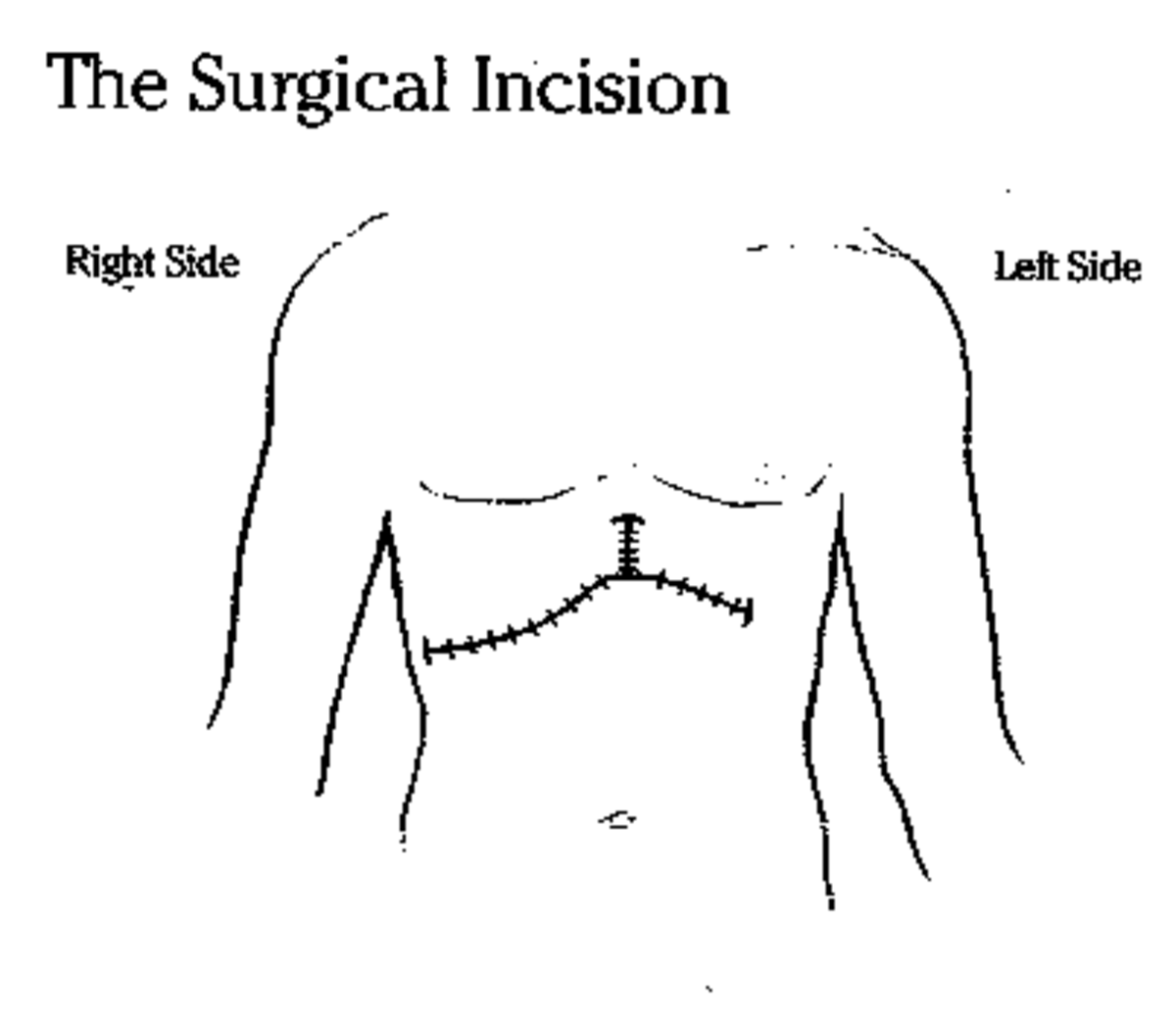 Surgical Incision
